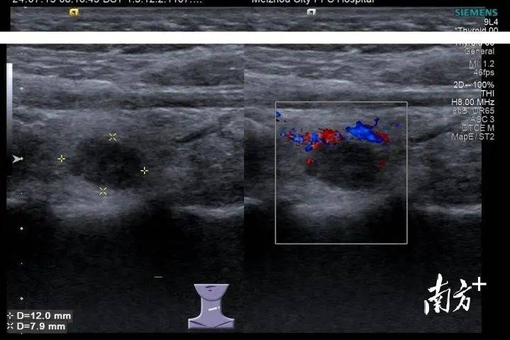 从东北到梅州,跨越3000公里的求医之路……