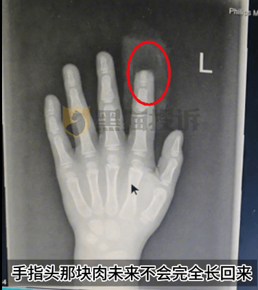 小鹏汽车回应“X9屏幕夹断5岁男童半节食指”