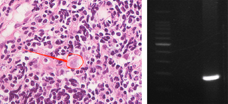 上海确诊1例!张文宏团队参与会诊!病死率极高,发病一周内迅速恶化