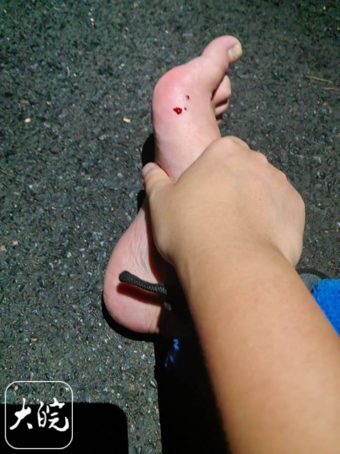 合肥一市民夜爬大蜀山被毒蛇咬伤 公园管理处呼吁：尽量避免夜间登山