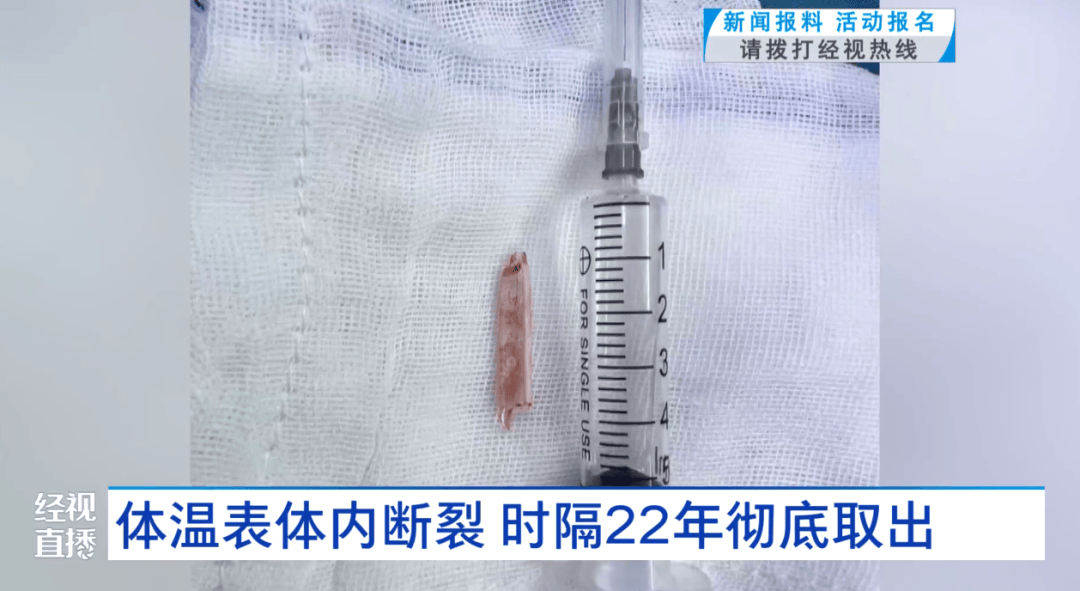 体温表在体内断裂，女子时隔22年彻底取出！医生：庆幸水银不在里面